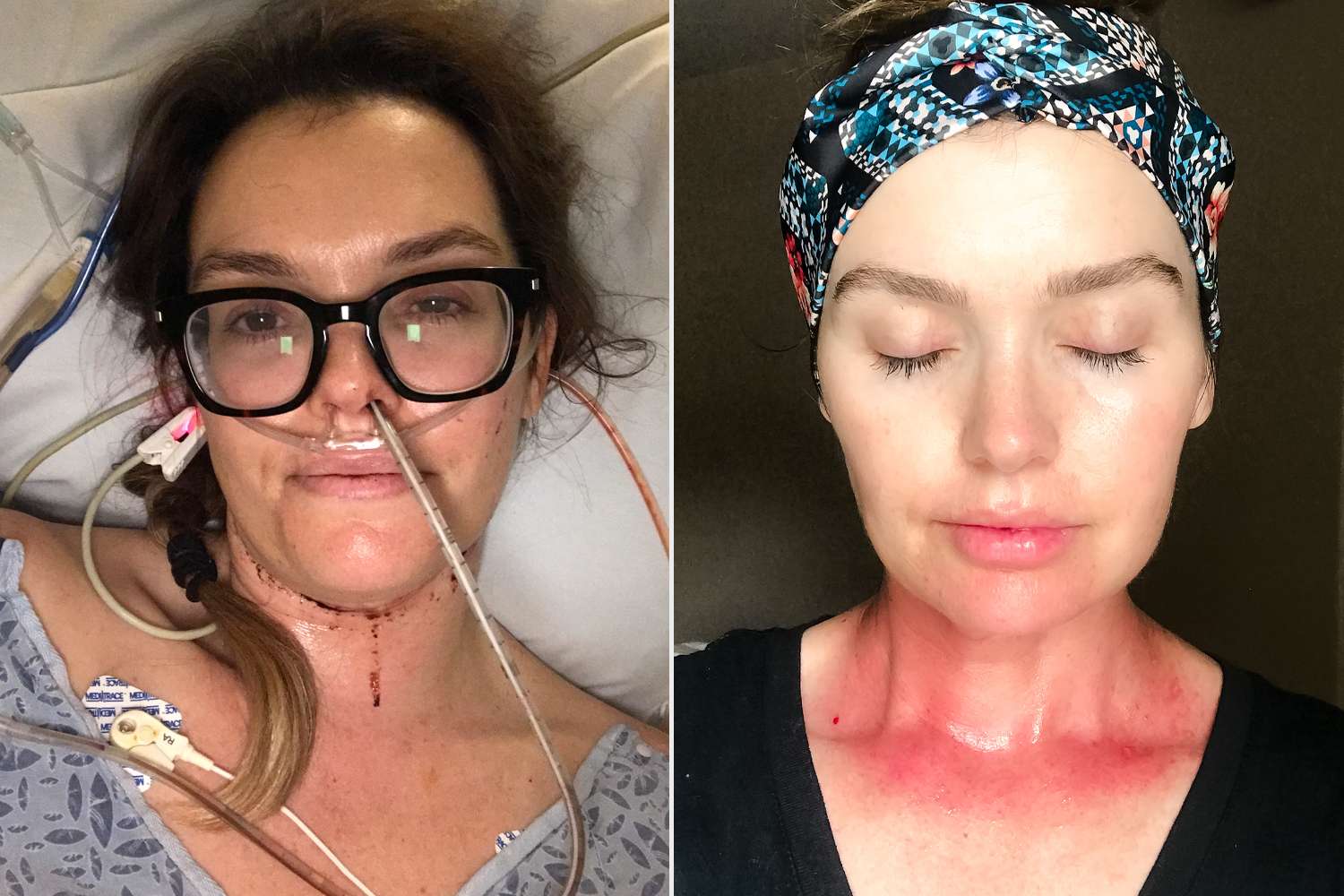 Cancer Survivor Shares Her Journey Five Years After Tongue Surgery and